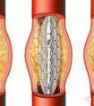 心臟支架國產(chǎn)的和進口的有什么區(qū)別？